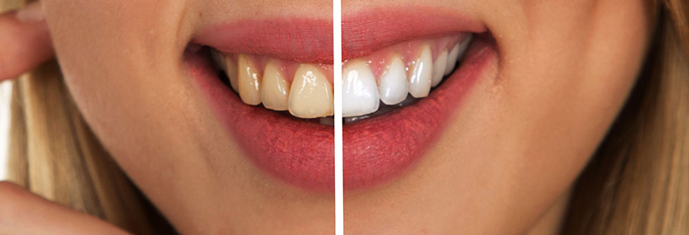 bleaching – Özel İlke Ağız ve Diş Sağlığı Polikliniği