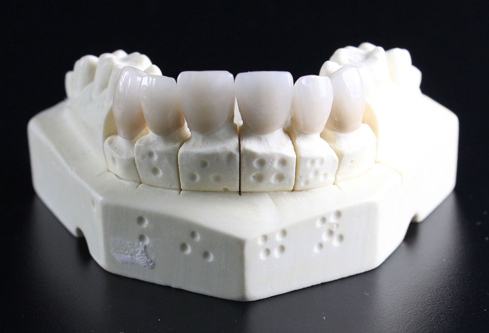 zirkonyum 1 – Özel İlke Ağız ve Diş Sağlığı Polikliniği