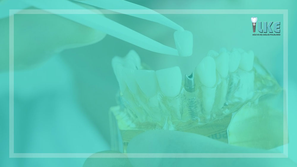 implant blog banner – Özel İlke Ağız ve Diş Sağlığı Polikliniği