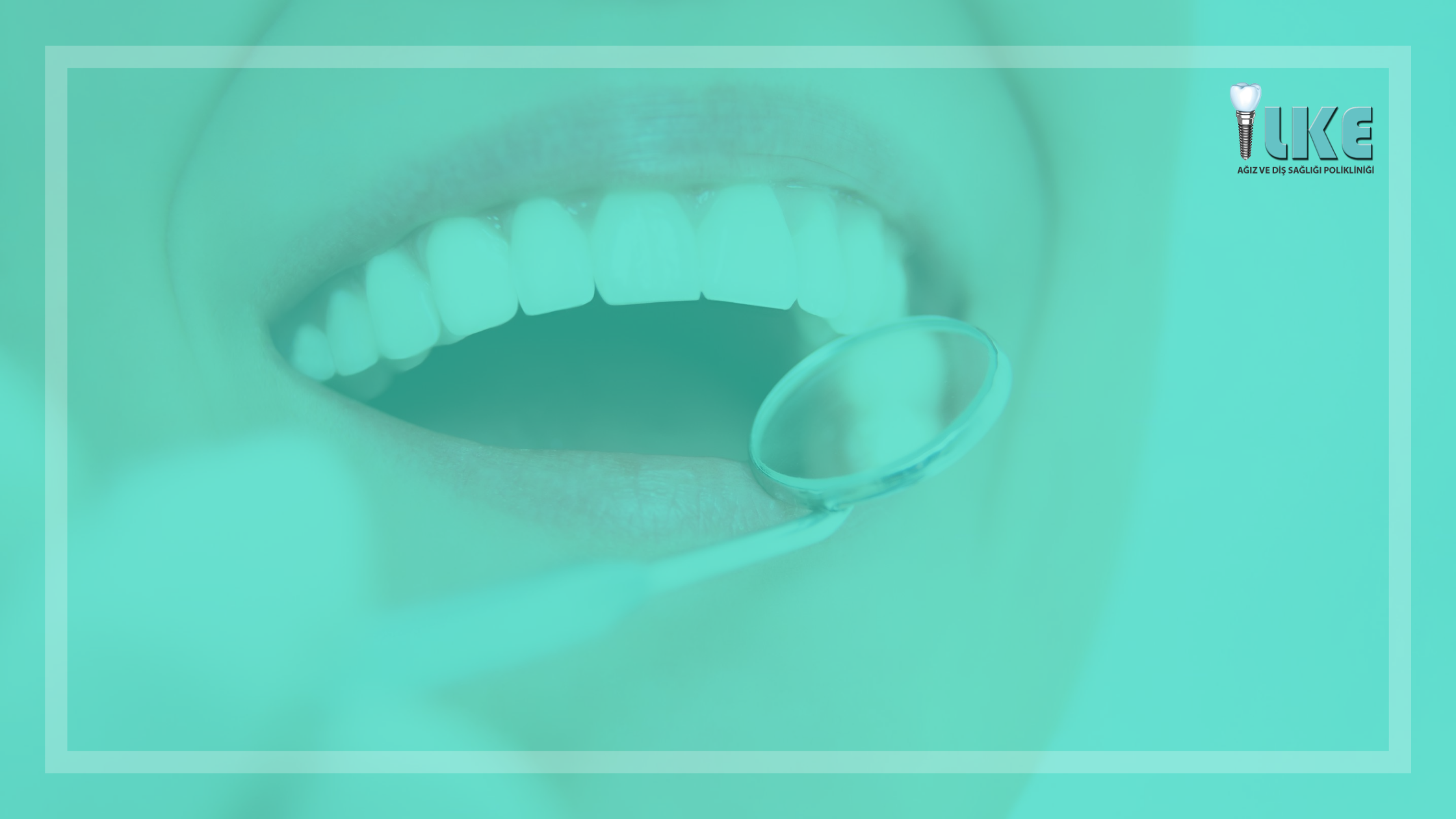 kanal tedavisi blog banner – Özel İlke Ağız ve Diş Sağlığı Polikliniği